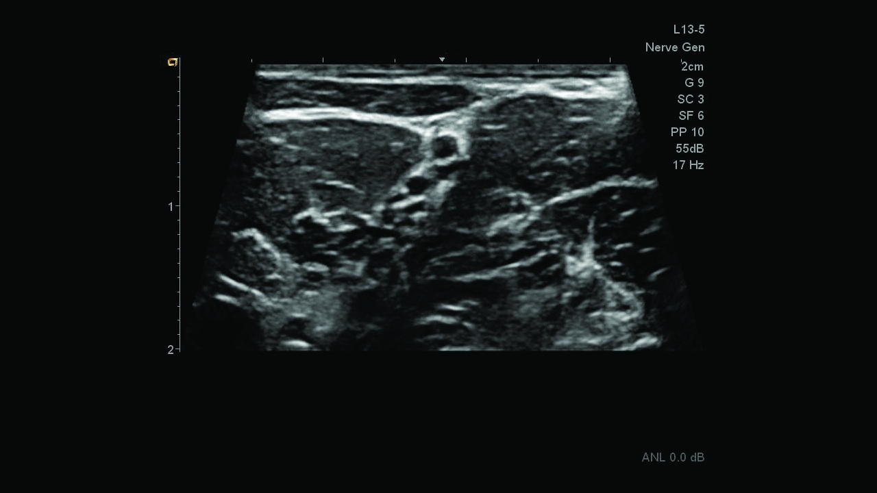 Siemens Acuson Freestyle Ultrasound Reduce exam time using Pixelformer™ image processing architecture to automate focal zones and visualize the common femoral artery.