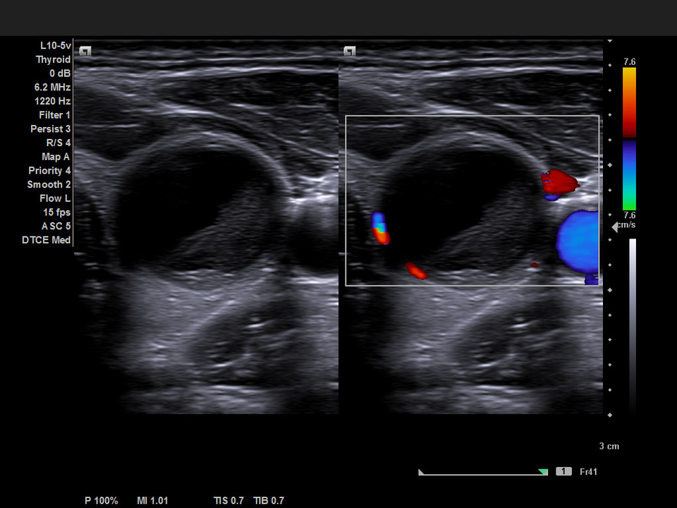 Siemens Acuson NX2 Ultrasound Cystic Thyroid Nodule