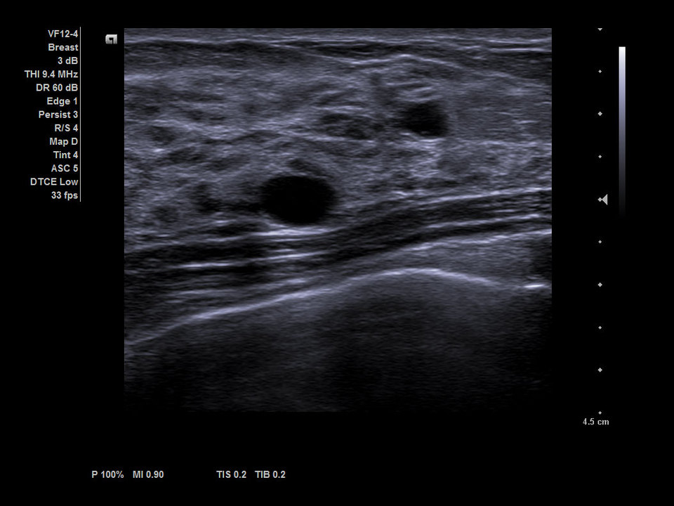 Siemens Acuson NX3 Ultrasound Breast cysts