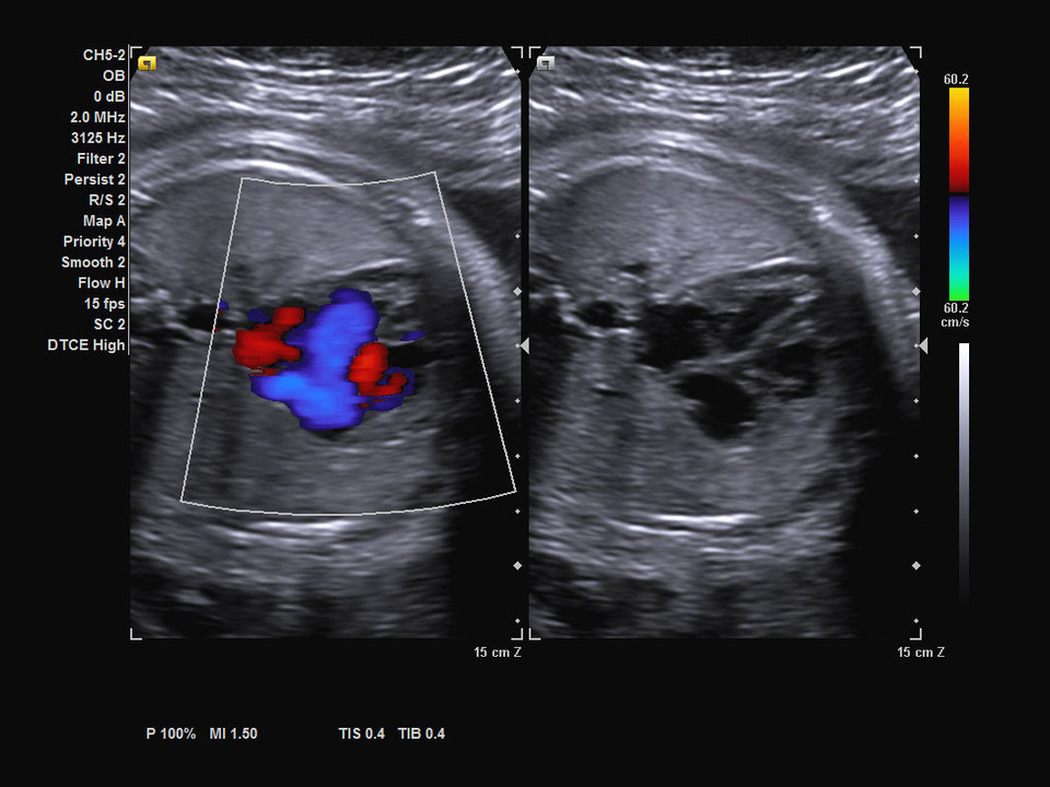 Siemens Acuson NX3 Ultrasound Color Doppler of fetal heart