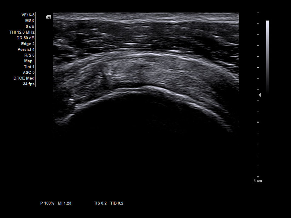 Siemens Acuson NX3 Ultrasound Supraspinatus tendon