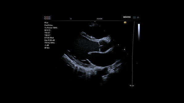 Siemens Acuson P500 Ultrasound Motion correction technology improves diagnostic confidence while performing dynamic scans of Parasternal Long-Axis (PLAX) view.