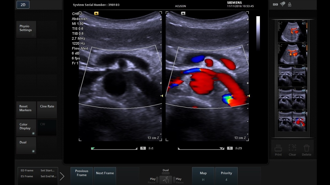 Siemens Acuson P500 Ultrasound Clarify Vascular Enhancement (VE) Technology