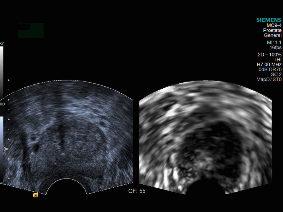 Siemens Acuson S1000 Ultrasound Prostate with eSie Touch elasticity imaging