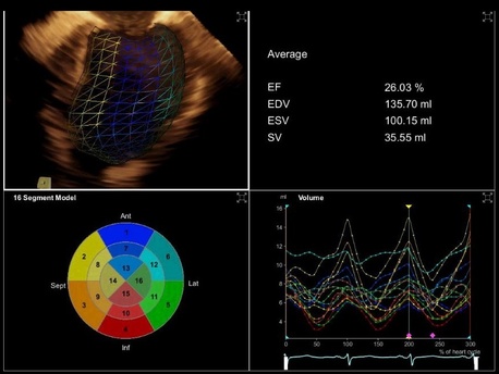 Siemens Acuson SC2000 Ultrasound Left ventricular analysis (LVA) performed on a dilated heart imaged with the Z6Ms True Volume TEE transducer