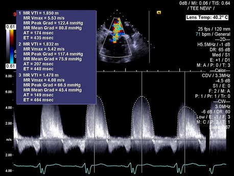 Siemens Acuson SC2000 Ultrasound One-click measurement of VTI on a CW Doppler trace of mitral regurgitation (MR) obtained with Z6Ms True Volume TEE using eSie Measure package
